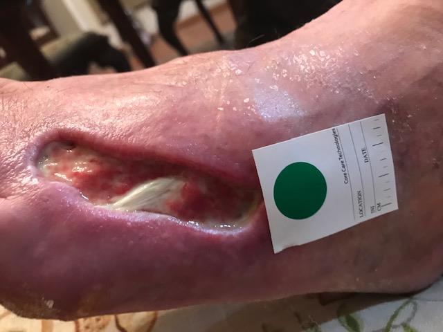 Manno-Deep Dorsal Foot Wound Infection